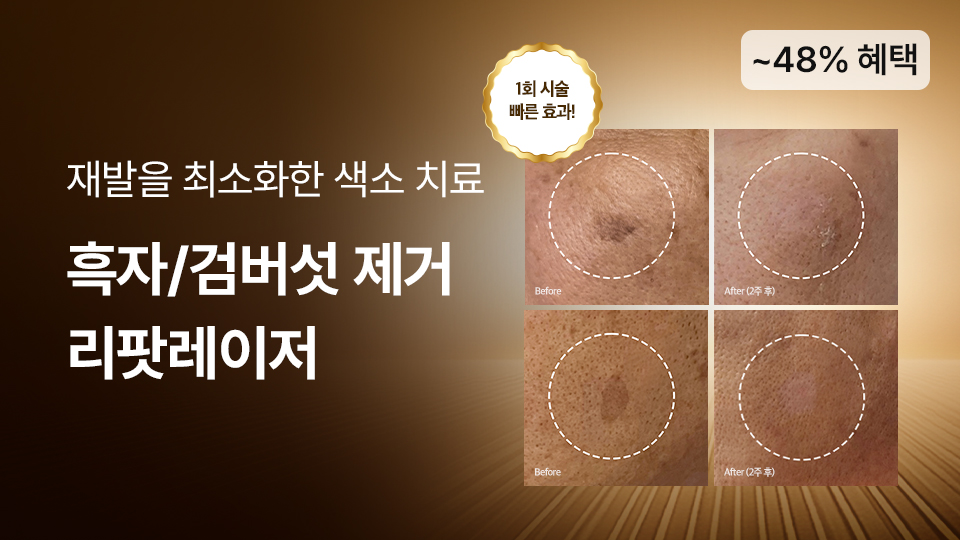 리팟레이저